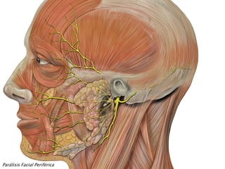Parálisis Facial Periférica