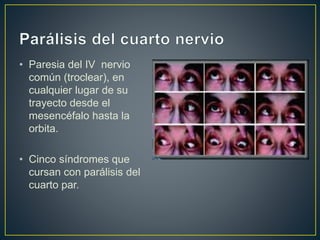 • Paresia del IV nervio
común (troclear), en
cualquier lugar de su
trayecto desde el
mesencéfalo hasta la
orbita.
• Cinco síndromes que
cursan con parálisis del
cuarto par.
 
