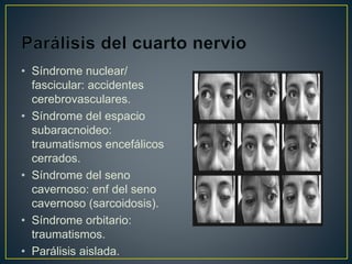• Síndrome nuclear/
fascicular: accidentes
cerebrovasculares.
• Síndrome del espacio
subaracnoideo:
traumatismos encefálicos
cerrados.
• Síndrome del seno
cavernoso: enf del seno
cavernoso (sarcoidosis).
• Síndrome orbitario:
traumatismos.
• Parálisis aislada.
 