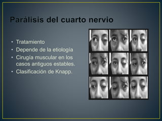 • Tratamiento
• Depende de la etiología
• Cirugía muscular en los
casos antiguos estables.
• Clasificación de Knapp.
 