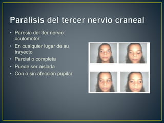 • Paresia del 3er nervio
oculomotor
• En cualquier lugar de su
trayecto
• Parcial o completa
• Puede ser aislada
• Con o sin afección pupilar
 