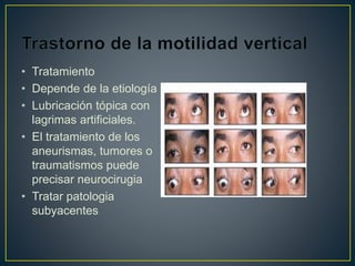 • Tratamiento
• Depende de la etiología
• Lubricación tópica con
lagrimas artificiales.
• El tratamiento de los
aneurismas, tumores o
traumatismos puede
precisar neurocirugia
• Tratar patologia
subyacentes
 