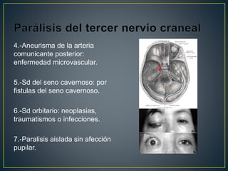 4.-Aneurisma de la arteria
comunicante posterior:
enfermedad microvascular.
5.-Sd del seno cavernoso: por
fistulas del seno cavernoso.
6.-Sd orbitario: neoplasias,
traumatismos o infecciones.
7.-Paralisis aislada sin afección
pupilar.
 
