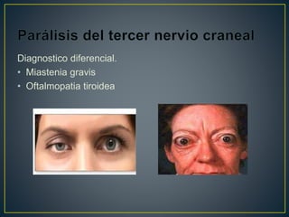 Diagnostico diferencial.
• Miastenia gravis
• Oftalmopatia tiroidea
 