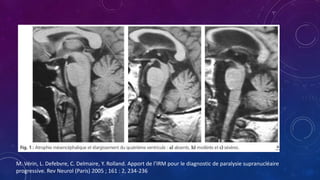 M. Vérin, L. Defebvre, C. Delmaire, Y. Rolland. Apport de l’IRM pour le diagnostic de paralysie supranucléaire
progressive. Rev Neurol (Paris) 2005 ; 161 : 2, 234-236
 