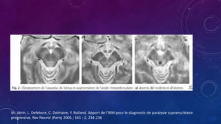 M. Vérin, L. Defebvre, C. Delmaire, Y. Rolland. Apport de l’IRM pour le diagnostic de paralysie supranucléaire
progressive. Rev Neurol (Paris) 2005 ; 161 : 2, 234-236
 
