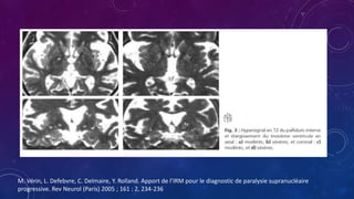 M. Vérin, L. Defebvre, C. Delmaire, Y. Rolland. Apport de l’IRM pour le diagnostic de paralysie supranucléaire
progressive. Rev Neurol (Paris) 2005 ; 161 : 2, 234-236
 
