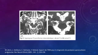 M. Vérin, L. Defebvre, C. Delmaire, Y. Rolland. Apport de l’IRM pour le diagnostic de paralysie supranucléaire
progressive. Rev Neurol (Paris) 2005 ; 161 : 2, 234-236
 