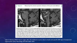 Luke A. Massey, MRCP Hans R. Jäger, MD. The midbrain to pons ratio A simple and specific MRI sign of progressive
supranuclear palsy. Neurology 2013;80:1856–1861
 