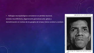 • Hallazgos neuropatológicos consistieron en pérdida neuronal,
enredos neurofibrilares, degeneración granulovacuolar, gliosis y
demielinización en núcleos de los ganglios de la base, tronco cerebral y cerebelo
 