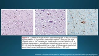 Movement Disorders Clinical Practice; “Rapidly progressive Supranuclear Palsy” (2014); página 71.
 