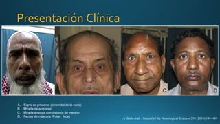 Presentación Clínica
A. Signo de procerus (piramidal de la nariz)
B. Mirada de sorpresa
C. Mirada ansiosa con distonía de mentón
D. Facies de máscara (Poker face)
A. Batla et al. / Journal of the Neurological Sciences 298 (2010) 148–149
 