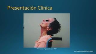 Presentación Clínica
Retrocolis en paciente con PSP
Arq Neuropsiquiatr 2010;68(6)
 