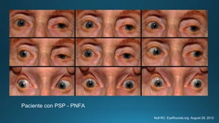 Null RC. EyeRounds.org. August 29, 2012
Paciente con PSP - PNFA
 