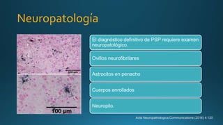 Neuropatología
Acta Neuropathologica Communications (2016) 4:120
El diagnóstico definitivo de PSP requiere examen
neuropatológico.
Ovillos neurofibrilares
Astrocitos en penacho
Cuerpos enrollados
Neuropilo.
 
