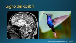 Signo del colibrí
Revista Argentina de Radiología, 2015-79, 3, 170-171
 