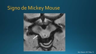 Signo de Mickey Mouse
Mov Disord. 2017 May 13
 