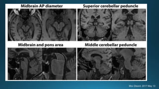 Mov Disord. 2017 May 13
 