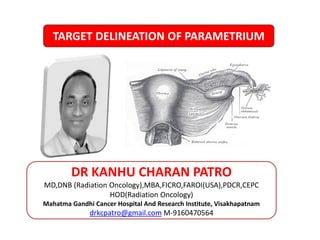 MANAGEMENT OF DIFFUSE GLIOMAS
5/12/2023 1
DR KANHU CHARAN PATRO
MD,DNB (Radiation Oncology),MBA,FICRO,FAROI(USA),PDCR,CEPC
HOD(Radiation Oncology)
Mahatma Gandhi Cancer Hospital And Research Institute, Visakhapatnam
drkcpatro@gmail.com M-9160470564
TARGET DELINEATION OF PARAMETRIUM
 