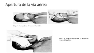 Apertura de la vía aérea
 