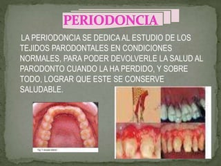 LA PERIODONCIA SE DEDICA AL ESTUDIO DE LOS
TEJIDOS PARODONTALES EN CONDICIONES
NORMALES, PARA PODER DEVOLVERLE LA SALUD AL
PARODONTO CUANDO LA HA PERDIDO, Y SOBRE
TODO, LOGRAR QUE ESTE SE CONSERVE
SALUDABLE.
 