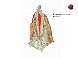 Ruptura del anillo de Kolhiker