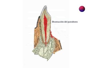 Destrucción del parodonto