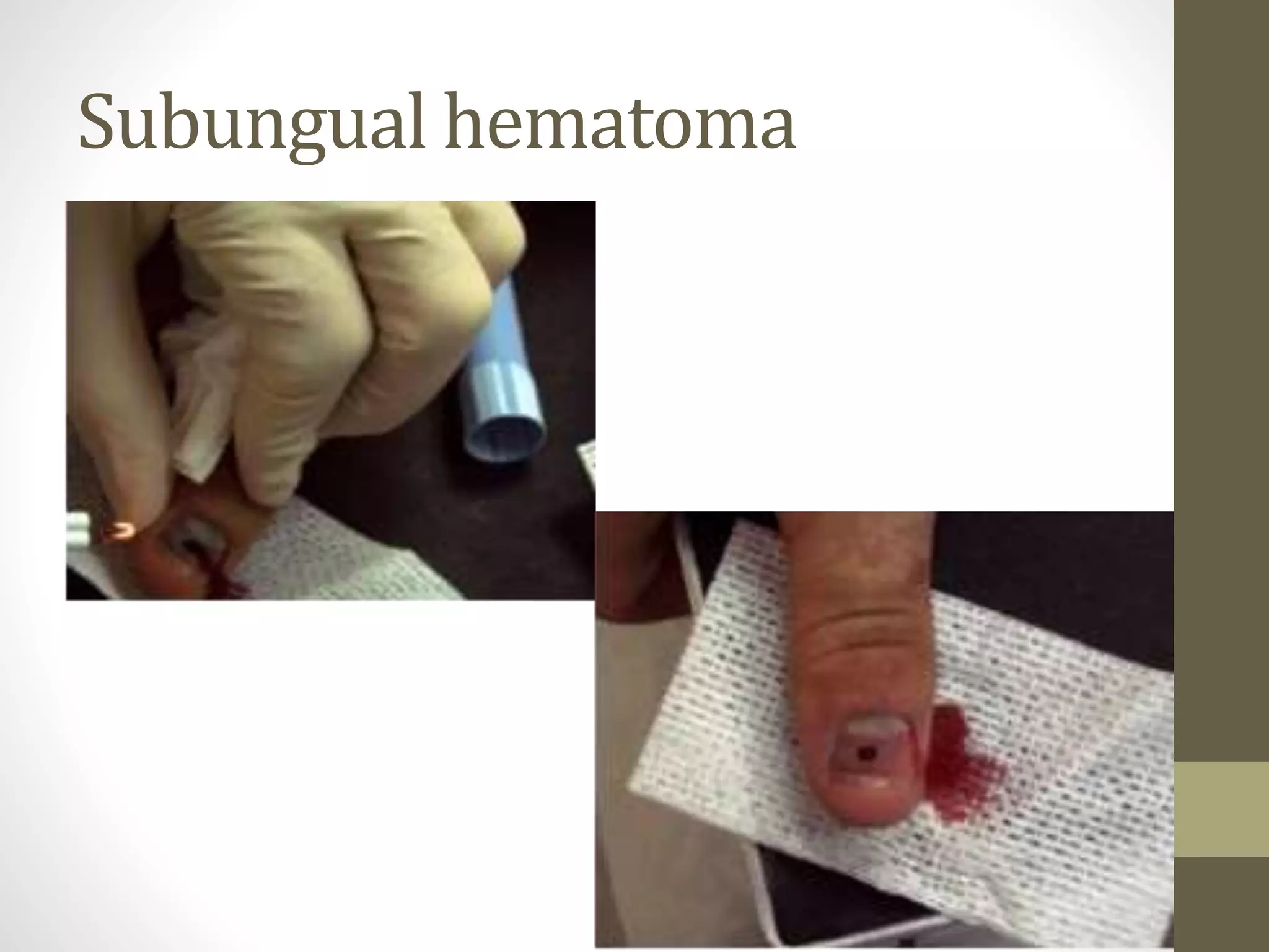 Subungual hematoma
 