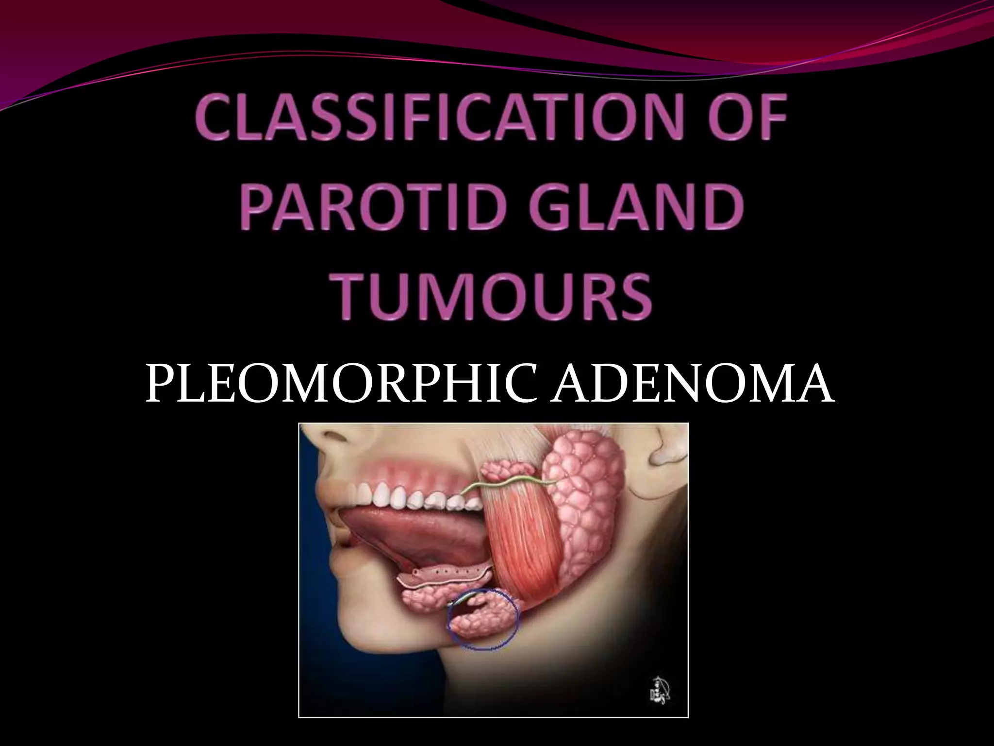 Define Pleomorphic Pleomorphic adenoma | PPTX