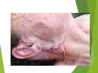 Parotid Incision Types Comprehensive Guide to Parotidectomy Surgical Procedure and Care | PPTX