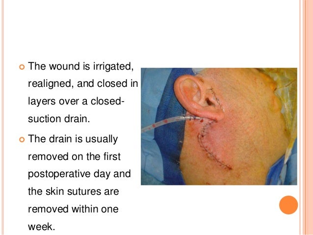 parotidectomy