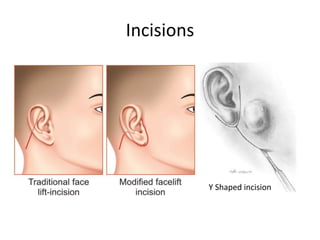 Parotid Incision Types Parotidectomy : Operative Technique | PPTX