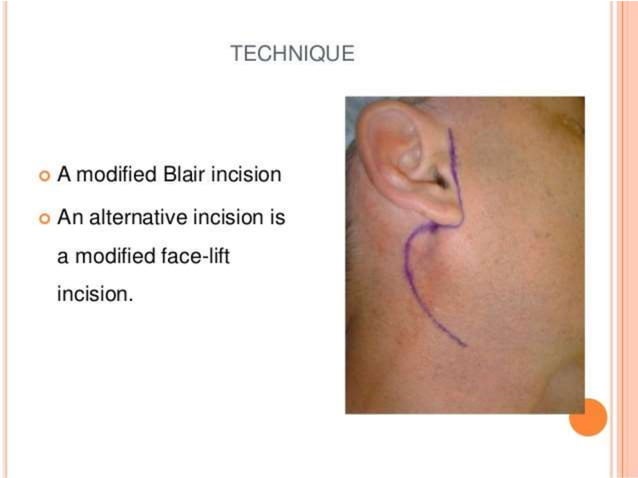 Parotid Incision Types Parotidectomy | PPTX