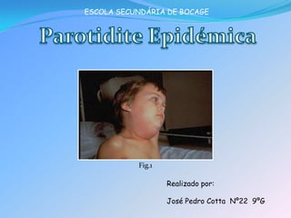 ESCOLA SECUNDÁRIA DE BOCAGE Parotidite Epidémica Fig.1 Realizado por: José Pedro Cotta  Nº22  9ºG 