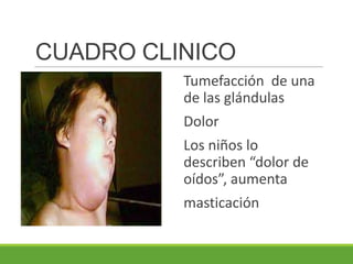 CUADRO CLINICO
Tumefacción de una
de las glándulas
Dolor
Los niños lo
describen “dolor de
oídos”, aumenta
masticación
 