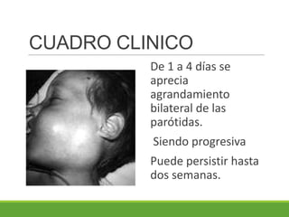 CUADRO CLINICO
De 1 a 4 días se
aprecia
agrandamiento
bilateral de las
parótidas.
Siendo progresiva
Puede persistir hasta
dos semanas.
 