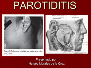 PAROTIDITISPAROTIDITIS
Presentado por:Presentado por:
Hatuey Morales de la CruzHatuey Morales de la Cruz
 