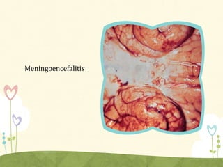 Meningoencefalitis
 