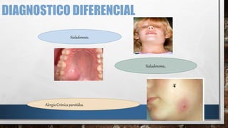 DIAGNOSTICO DIFERENCIAL
Sialadenosis.
Sialadenoma.
Alergia Crónica parotídea.
 