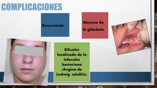 COMPLICACIONES
Absceso de
la glándula.
Difusión
localizada de la
infección
bacteriana
(Angina de
Ludwig, celulitis).
Recurrencia.
 