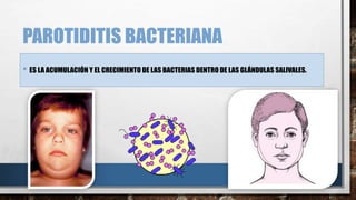 PAROTIDITIS BACTERIANA
• ES LA ACUMULACIÓN Y EL CRECIMIENTO DE LAS BACTERIAS DENTRO DE LAS GLÁNDULAS SALIVALES.
 