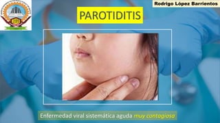 PAROTIDITIS
Enfermedad viral sistemática aguda muy contagiosa
Rodrigo López Barrientos
 
