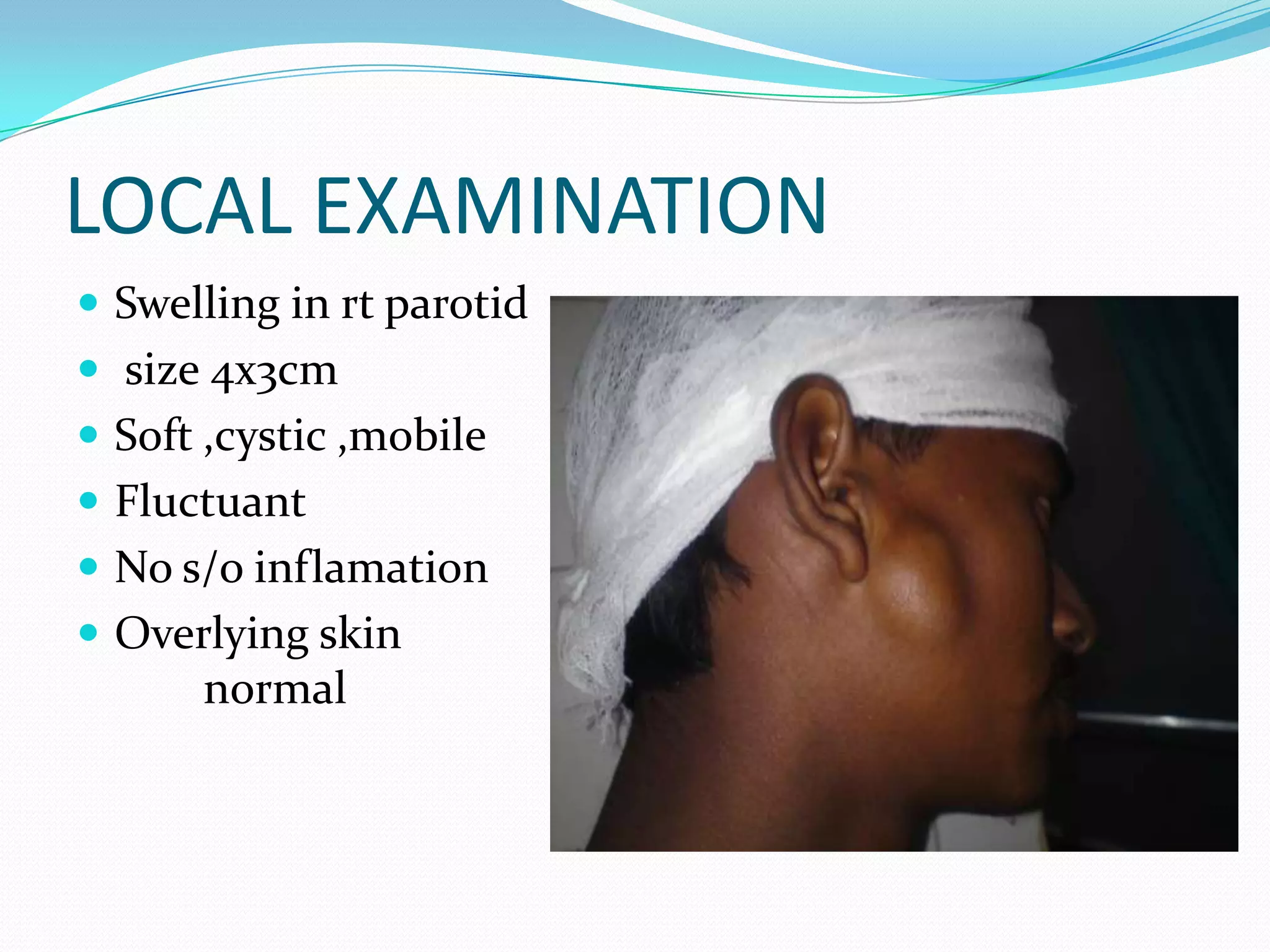 Parotid ppt | PPTX