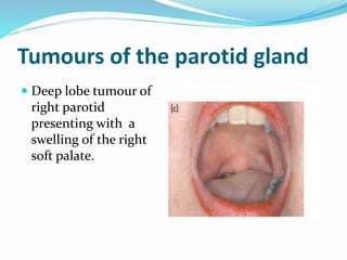 Tumours of the parotid gland
 Deep lobe tumour of
right parotid
presenting with a
swelling of the right
soft palate.
 