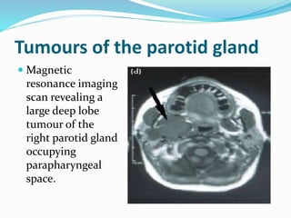 Tumours of the parotid gland
 Magnetic
resonance imaging
scan revealing a
large deep lobe
tumour of the
right parotid gland
occupying
parapharyngeal
space.
 