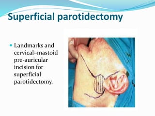 Superficial parotidectomy
 Landmarks and
cervical–mastoid
pre-auricular
incision for
superficial
parotidectomy.
 
