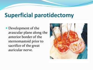Superficial parotidectomy
 Development of the
avascular plane along the
anterior border of the
sternomastoid prior to
sacrifice of the great
auricular nerve.
 