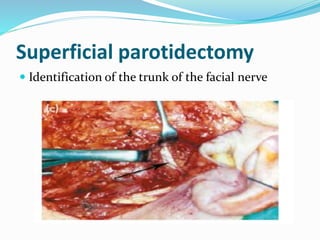 Superficial parotidectomy
 Identification of the trunk of the facial nerve
 