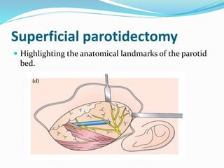 Superficial parotidectomy
 Highlighting the anatomical landmarks of the parotid
bed.
 