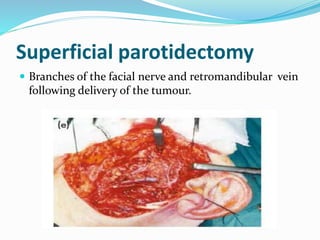 Superficial parotidectomy
 Branches of the facial nerve and retromandibular vein
following delivery of the tumour.
 